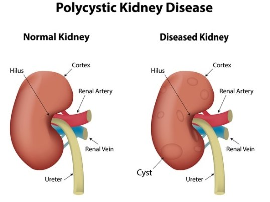 polycystic-kidney2